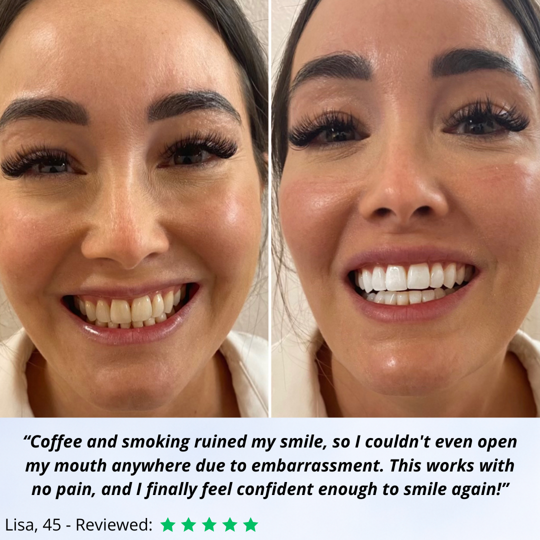 Erase years of stubborn stains without any pain or enamel damage